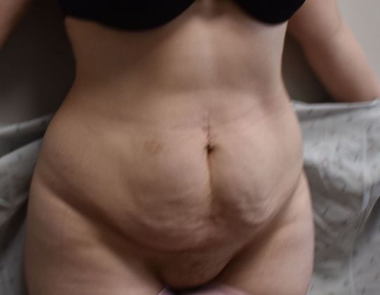 Tummy Tuck (Abdominoplasty): Case 305 - Before