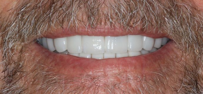 Full Mouth Reconstruction: Case 24 - After