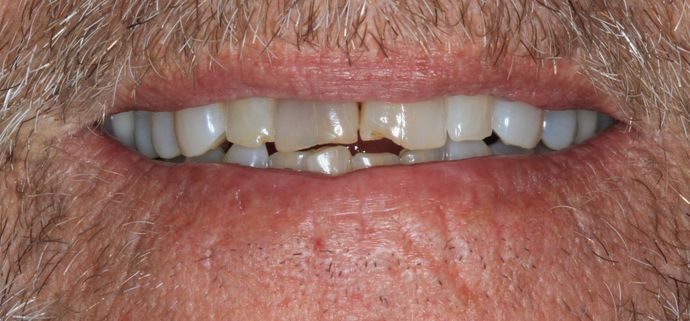 Full Mouth Reconstruction: Case 24 - Before