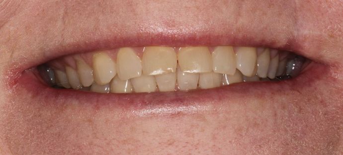 Porcelain Crowns: Case 17 - Before