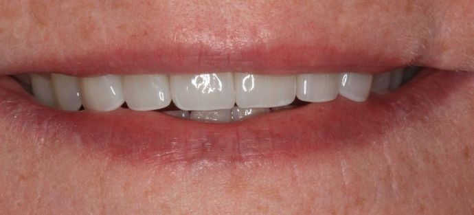 Porcelain Crowns: Case 17 - After