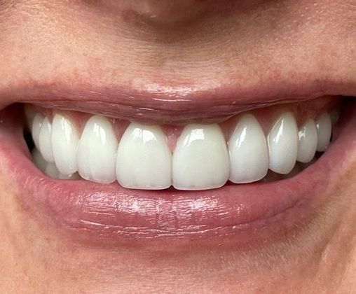 Smile Makeovers Case 7 - After