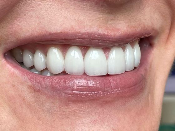 Smile Makeovers: Case 7 - After