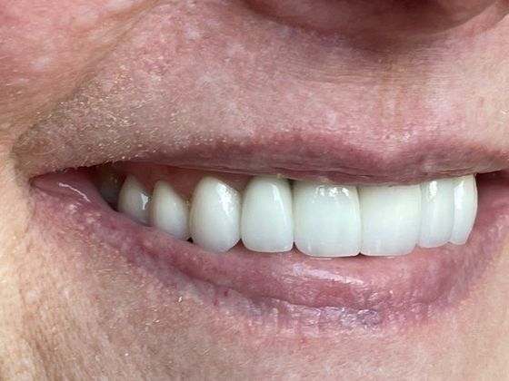 Smile Makeovers: Case 11 - After