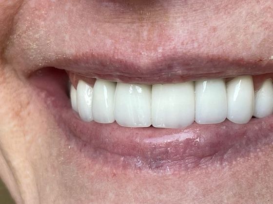 Smile Makeovers: Case 11 - After