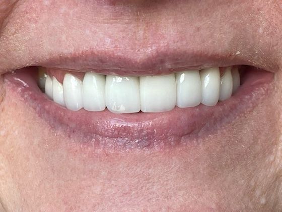 Smile Makeovers Case 11 - After