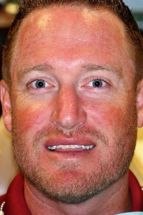 Veneers Case 18 - Before