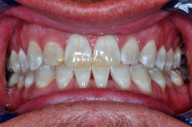 Veneers: Case 18 - Before