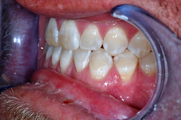 Veneers: Case 18 - Before