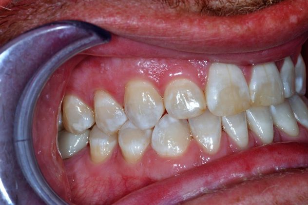 Veneers: Case 18 - Before