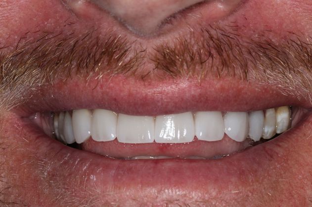 Veneers: Case 18 - After