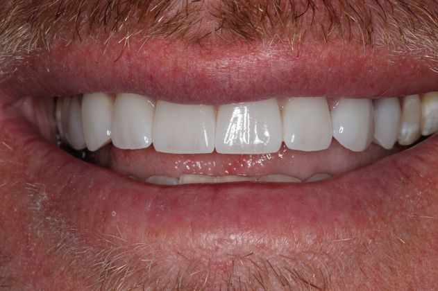 Veneers: Case 18 - After