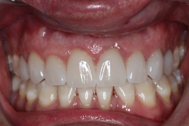 Veneers: Case 18 - After