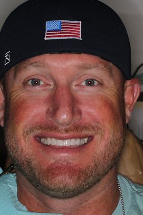 Veneers Case 18 - After