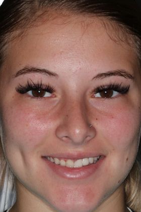 Veneers Case 19 - Before