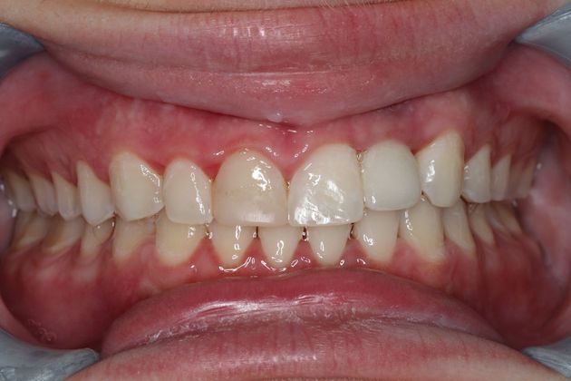 Veneers: Case 19 - Before