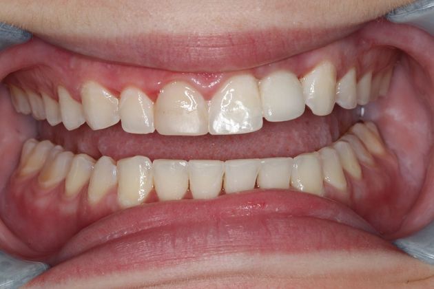 Veneers: Case 19 - Before