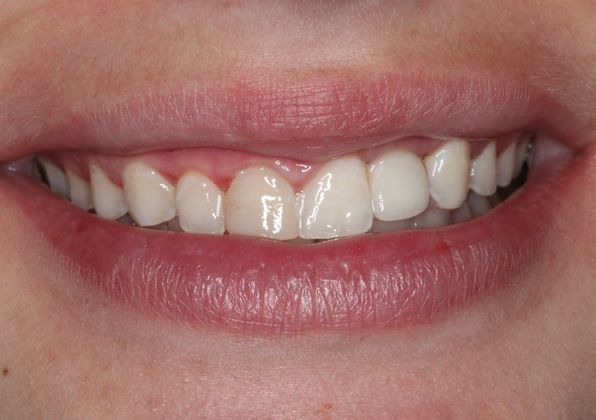 Veneers: Case 19 - Before