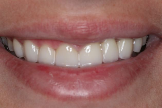 Veneers: Case 19 - After