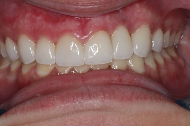 Veneers: Case 19 - After