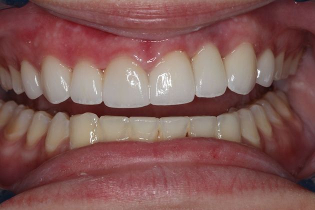 Veneers: Case 19 - After