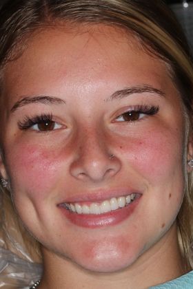 Veneers Case 19 - After