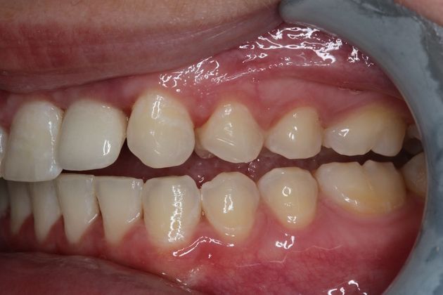 Dental Implants: Case 7 - Before