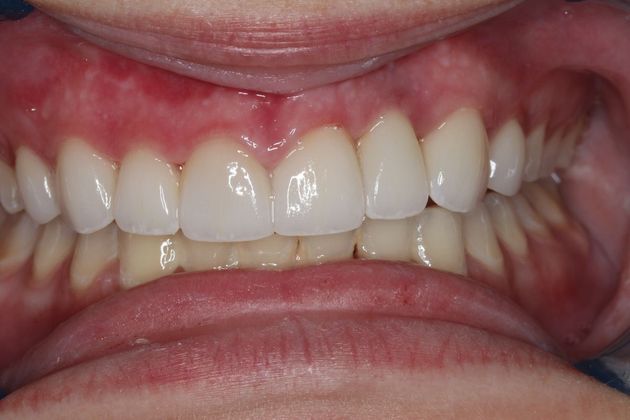 Dental Implants: Case 7 - After