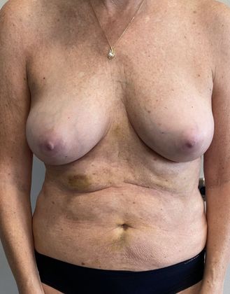 Liposuction: Case 16 Liposuction with Fat Grafting, Wilton, CT - After