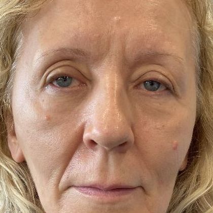 Eyelid Lift: Case 27 Upper Eyelid Lift, Westport, CT - Before
