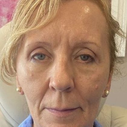 Eyelid Lift: Case 27 Upper Eyelid Lift, Westport, CT - After