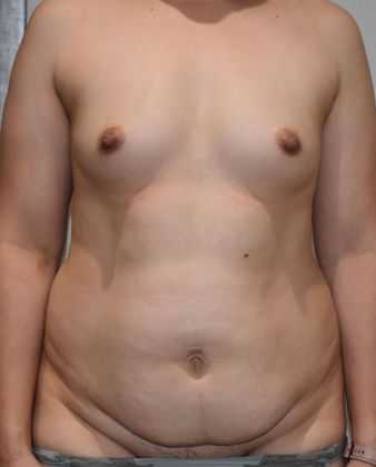 Mommy Makeover Case 203 - Before