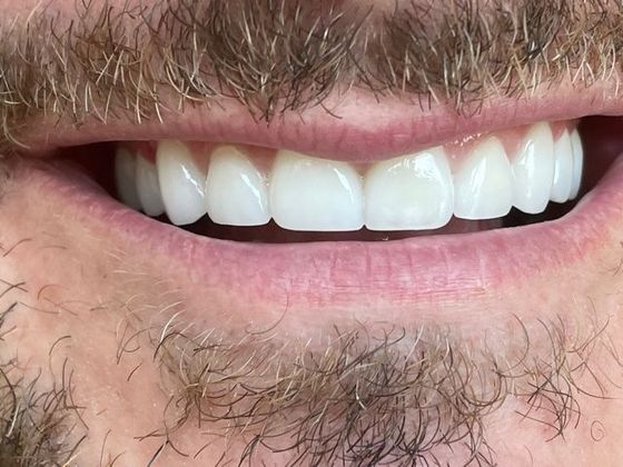 Porcelain Dental Crowns Case 3 - After