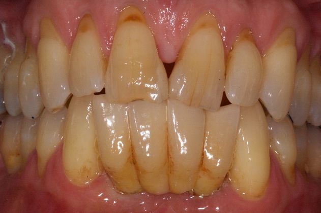 Implant Replacement of Mandibular Anterior Segment When gum disease destroys the lower front teeth... - After