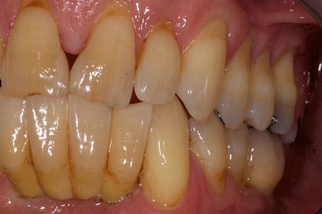 Implant Replacement of Mandibular Anterior Segment: When gum disease destroys the lower front teeth... - Before