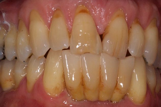 Implant Replacement of Mandibular Anterior Segment: When gum disease destroys the lower front teeth... - After