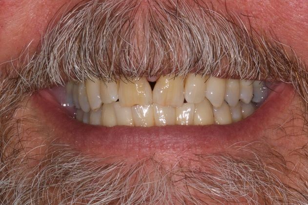 Implant Replacement of Mandibular Anterior Segment When gum disease destroys the lower front teeth... - Before