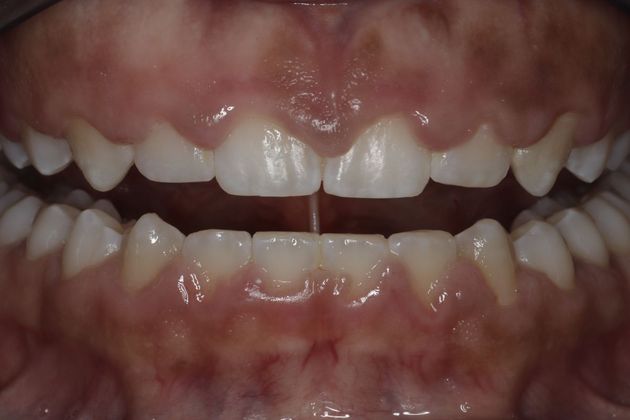 Laser Gum Reshaping Case 7 - Before