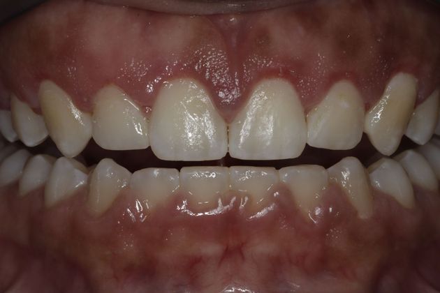 Laser Gum Reshaping Case 7 - After
