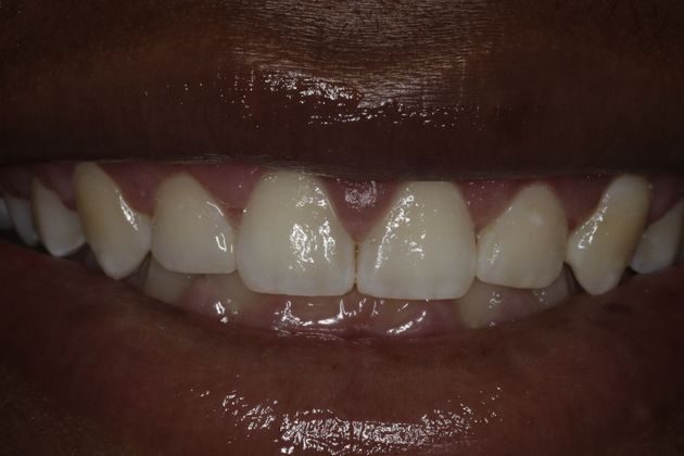 Laser Gum Reshaping: Case 7 - After