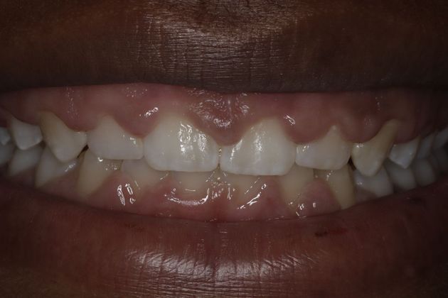 Laser Gum Reshaping: Case 7 - Before