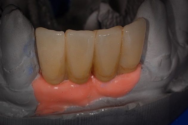 Implant Replacement of Mandibular Anterior Segment: When lower front teeth fracture! - After