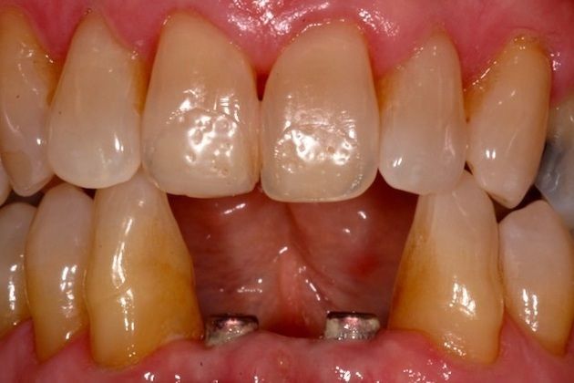 Implant Replacement of Mandibular Anterior Segment When lower front teeth fracture! - Before