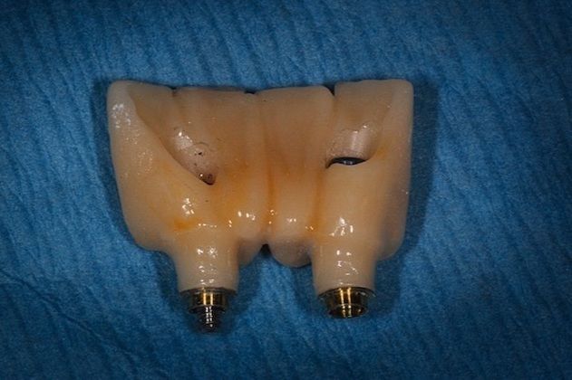 Implant Replacement of Mandibular Anterior Segment: When lower front teeth fracture! - Before