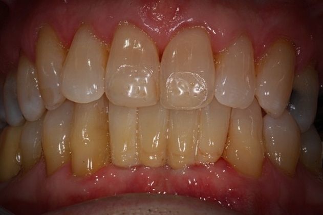 Implant Replacement of Mandibular Anterior Segment When lower front teeth fracture! - After