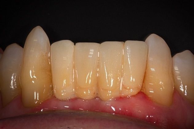 Implant Replacement of Mandibular Anterior Segment: When lower front teeth fracture! - After