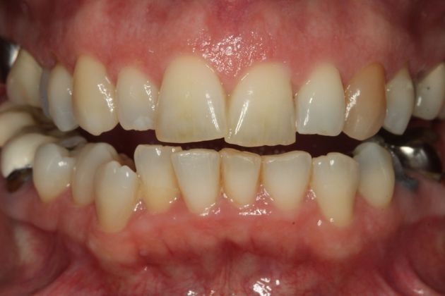 Invisalign Case 3 - Before