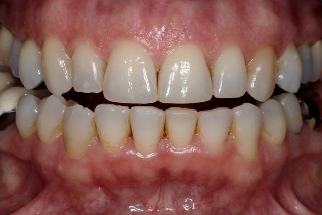 Invisalign: Case 3 - After