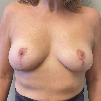 Breast Lift: Case 13 Breast Lift Fairfield, CT - After
