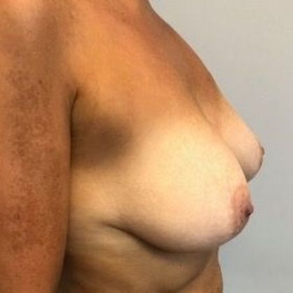 Breast Lift: Case 13 Breast Lift Fairfield, CT - Before